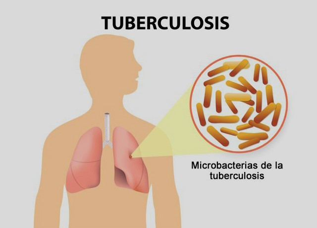 Tips Jitu Mempercepat Proses Penyembuhan Tuberkulosis